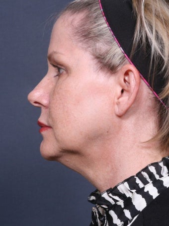 Neck Lift before 384956
