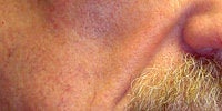 Sculptra before 272058