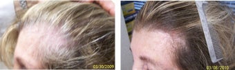 Female medical treatment for hair loss (no surgery) before 369185