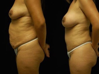 Tummy Tuck and Breast Augmentation 392095