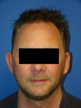 Ear Surgery (otoplasty) before 124914