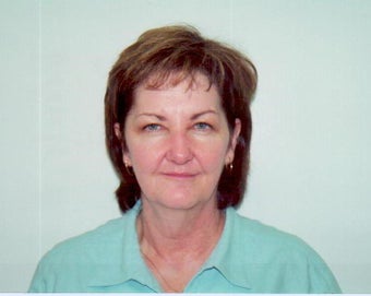 Face Lift w/ a Brow Lift and Upper & Lower Blepharoplasty before 237251