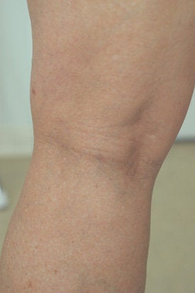Laser Spider Vein Removal after 106560