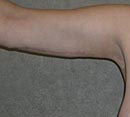 Arm Lift (Brachioplasty) after 142518