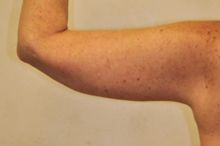Brachioplasty (Arm Lift) after 293439
