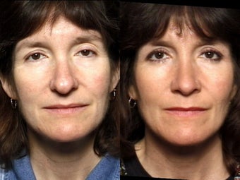 Rhinoplasty 339184