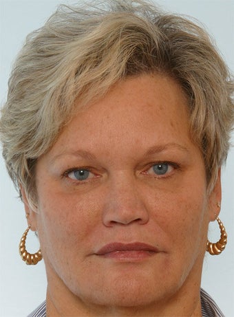 Botox Juvederm Restylane Radiesse after 260316