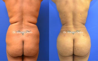 Brazilian Buttock Lift before 567099