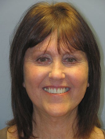 Neck Lift, Platysmaplasty after 634720