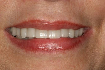 Dental implants, bone grafts, all porcelain crowns after 503116
