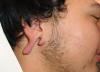 Repair of split earlobe before 548112