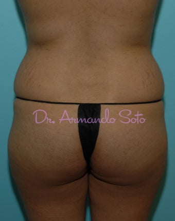 Brazilian Butt Lift before 207535