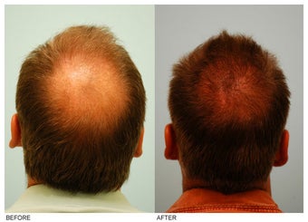 Crown (Vertex) Hair Transplant before 134773