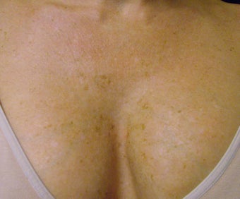 IPL - Intense Pulse Light after 414355
