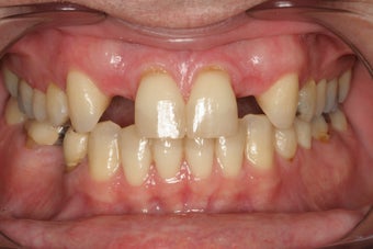 Whitening and Implants before 213055