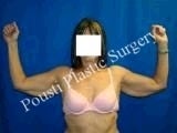 Arm Lift 644534