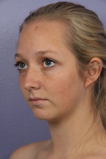 Chin Augmentation and Liposuction of the Neck before 611675