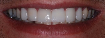 Veneers and Crowns after 141910
