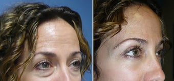 Cosmetic eyelid surgery before 127642
