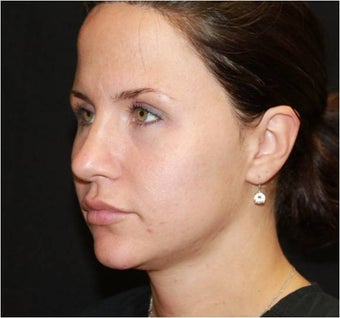 Ultherapy 434702
