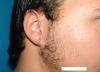 Repair of split earlobe after 548112