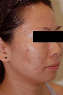 Laser Acne Treatment after 82971