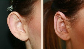 Otoplasty after 634260