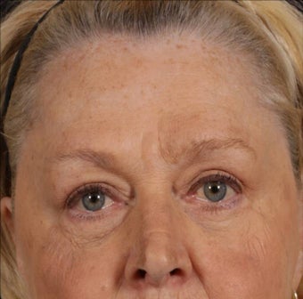 Blepharoplasty after 165947