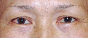 Upper Blepharoplasty before 365451