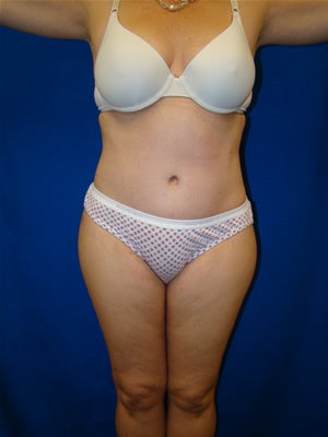 Tummy Tuck Surgery (abdominoplasty) after 127284