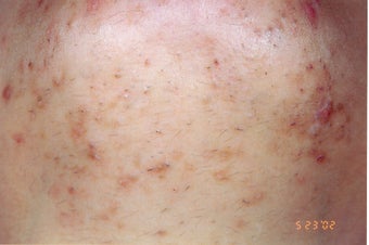 Chin folliculitis and LHR before 86769