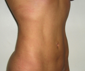 Vaser Liposuction after 229655