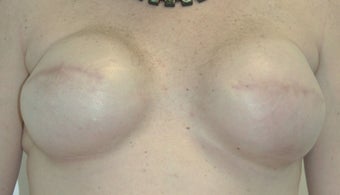 Breast Reconstruction 517542