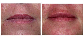 Lip Augmentation with Restylane before 69353