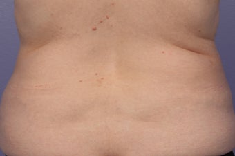 CoolSculpting to Bra Rolls/Back Fat after 414959