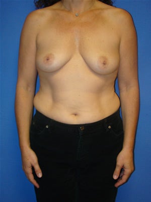 Breast Augmentation Surgery before 149370