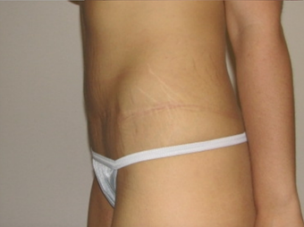 Tummy Tuck 410415