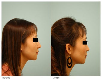 Asian Rhinoplasty before 136826