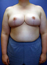 Breast Reduction after 96853