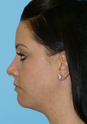 Chin Implant after 581194