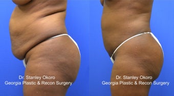 Mini Tummy Tuck after 568396