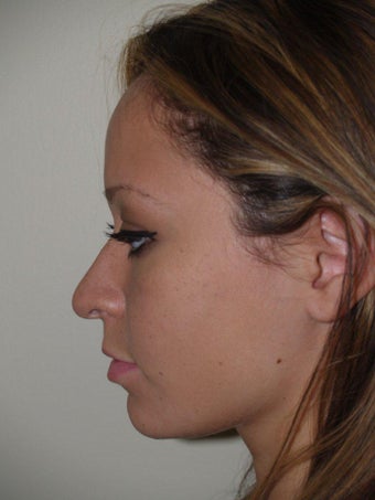 Rhinoplasty before 519756