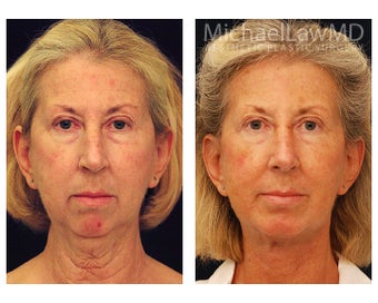 Facial Rejuvenation before 395135
