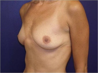 Breast Augmentation 427306
