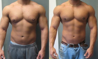 Gynecomastia Surgery 341129