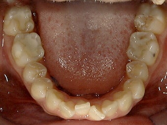 Invisalign before 273892