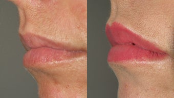 Lip Augmentation before 201508