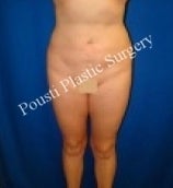 Liposuction after 632169
