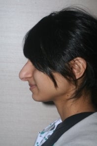 Asian Rhinoplasty 448668