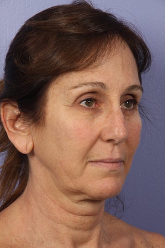 53 yr old Face and Necklift 622092